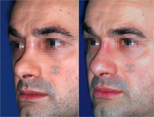 revision rhinoplasty before and after man 5