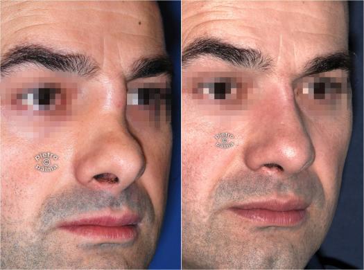 revision rhinoplasty before and after man 6