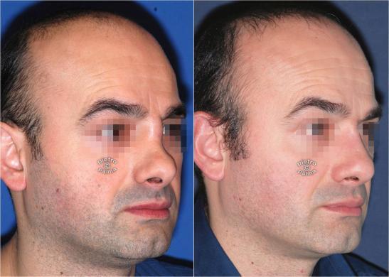 revision rhinoplasty before and after man 4