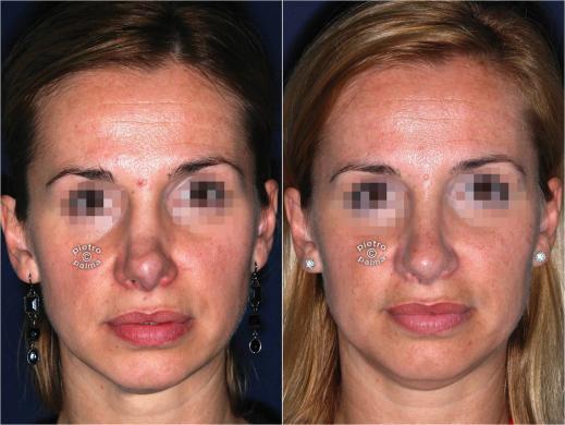 revision rhinoplasty before and after woman 1