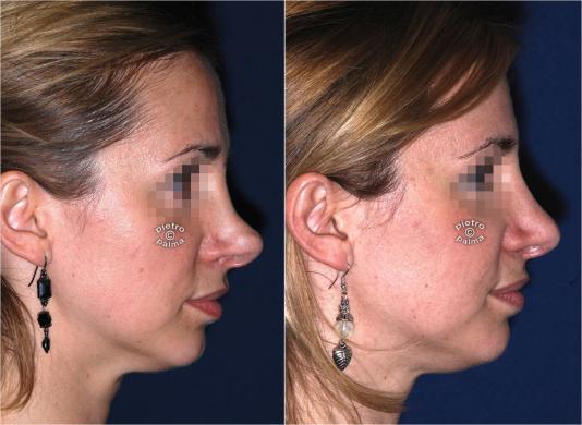 revision rhinoplasty before and after woman 2