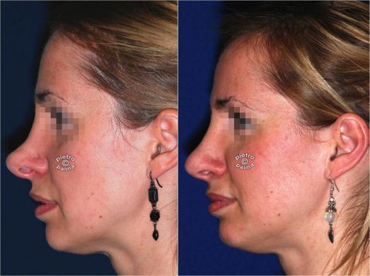 revision rhinoplasty before and after woman 3