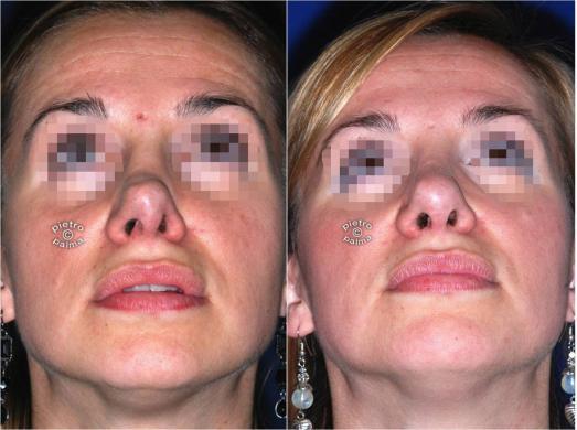 revision rhinoplasty before and after woman 4