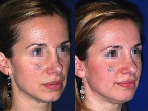 revision rhinoplasty before and after woman 5