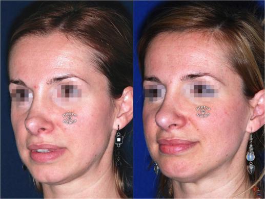 revision rhinoplasty before and after 7