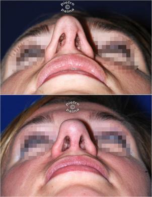 revision rhinoplasty before and after woman