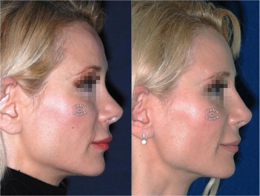 nose revision surgery before and after 1