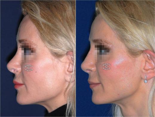 revision rhinoplasty before and after woman 0