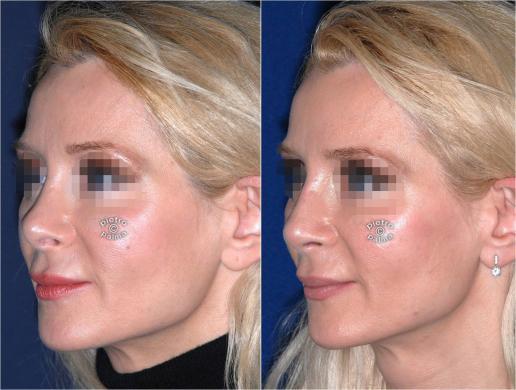 revision rhinoplasty before and after woman photo