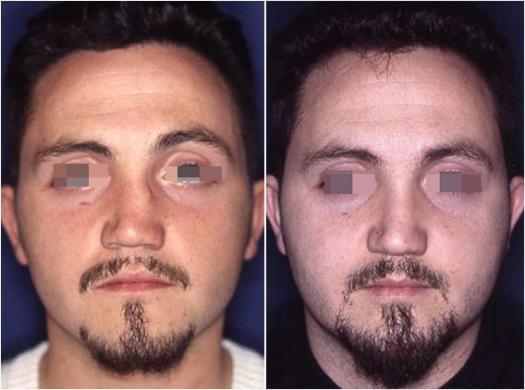 nose revision surgery before and after 3