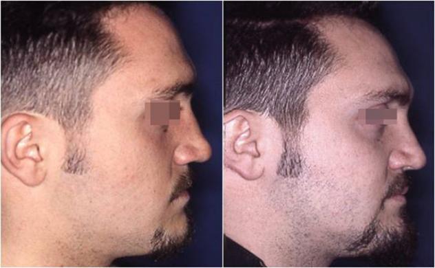 nose revision surgery before and after 4