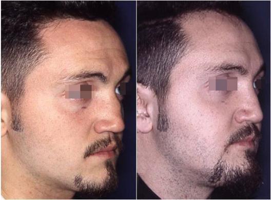 nose revision surgery before and after 2