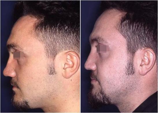 nose revision surgery before and after 7