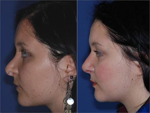 revision rhinoplasty 2