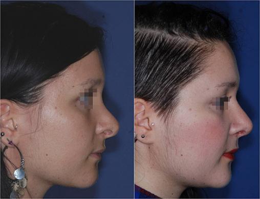 revision rhinoplasty 1