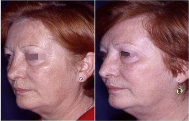 revision rhinoplasty before and after 9