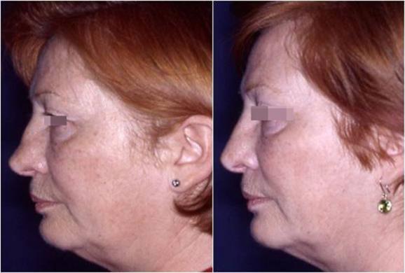 revision rhinoplasty