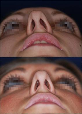 nose job revision before and after 4