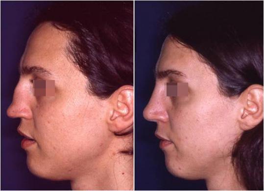 saddle nose rhinoplasty