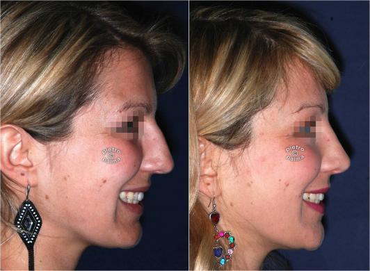 Nose Tip sculpting 7