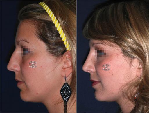 nose tip before and after 2