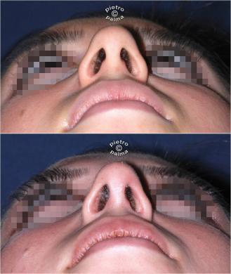 nose tip before and after 4