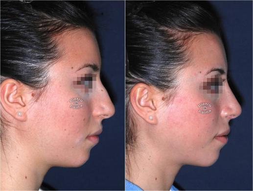 nose tip before and after 5