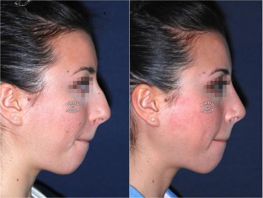 nose tip before and after 6