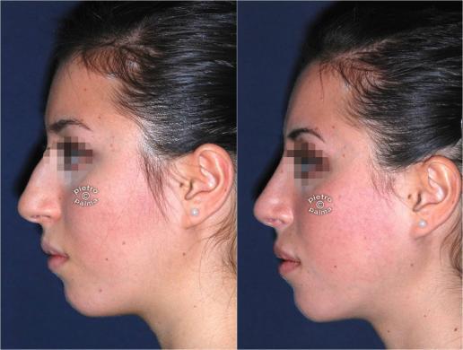 nasal tip surgery before and after