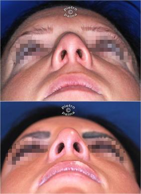 nasal tip surgery before and after 3