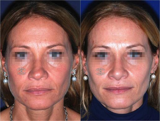 nose tip reduction before and after 2