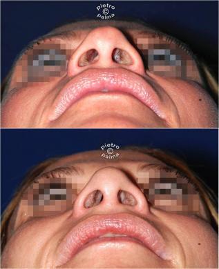 nose tip reduction before and after 3