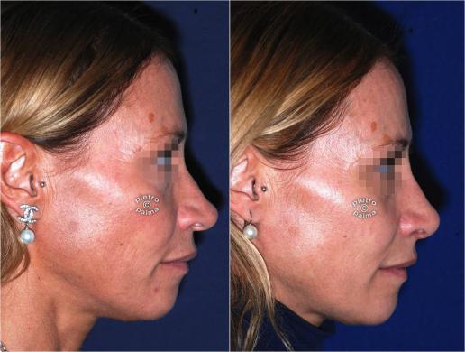 nose tip reduction before and after 5