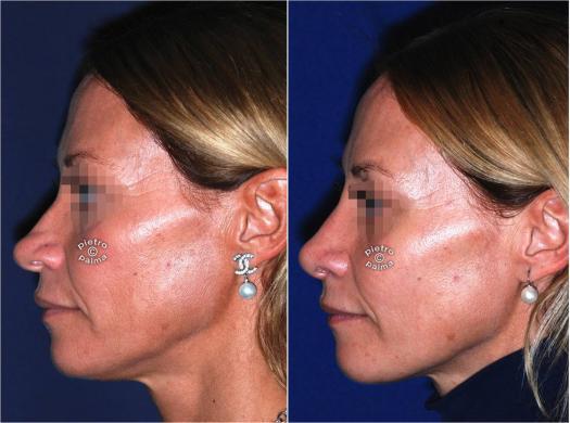 nose tip reduction before and after 7