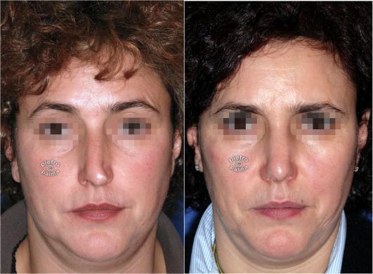 rhinoplasty before and after special cases woman 5