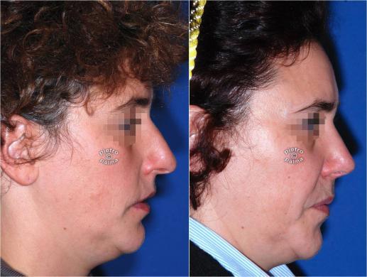 rhinoplasty before and after special cases woman 1