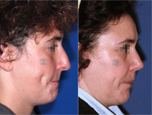 rhinoplasty before and after special cases woman 2