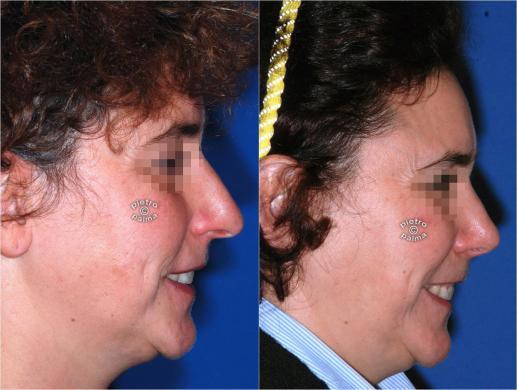 rhinoplasty before and after special cases image