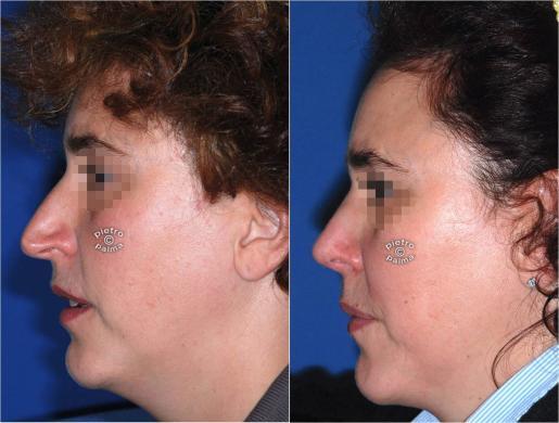 rhinoplasty before and after image