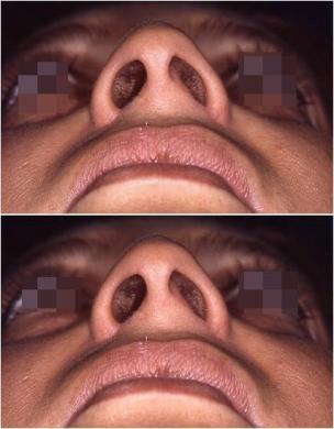 Drooping tip before and after 4