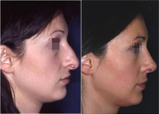 nasal tip surgery before and after 2