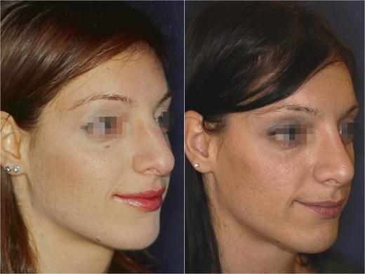 nose job before and after special cases woman