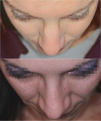 nose job before and after special cases woman 1