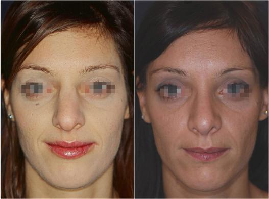 nose job before and after special cases woman 2